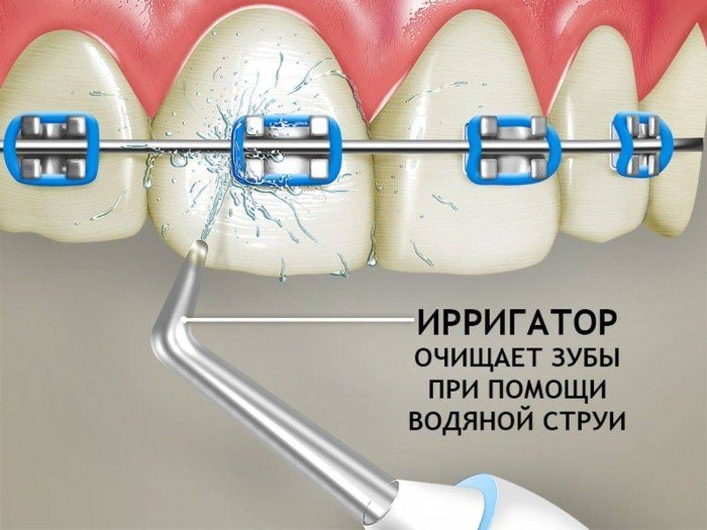 Ирригатор для ухода за зубами и брекетами: как правильно пользоваться